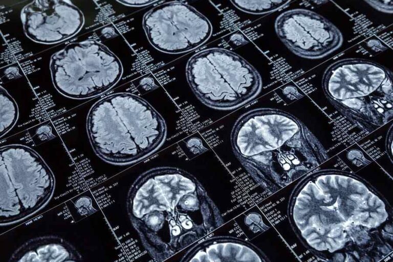 Tramatic Brain Injury