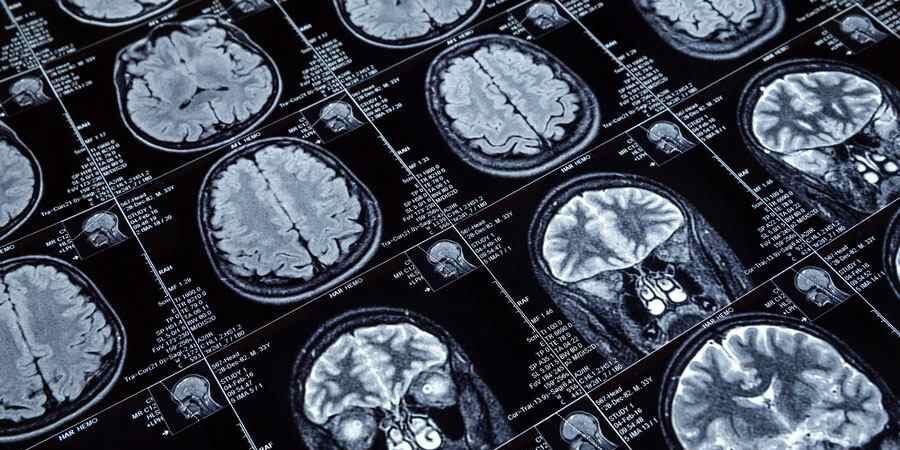 Tramatic Brain Injury